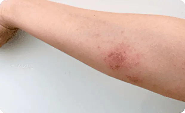 ノミやダニによる虫刺されで炎症を起こします